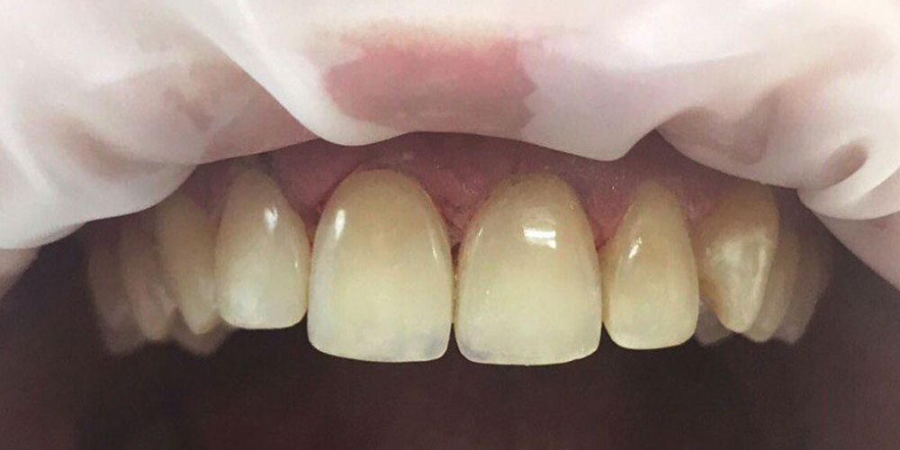  Реставрация зубов фронтальной группы зубов композитными материалами