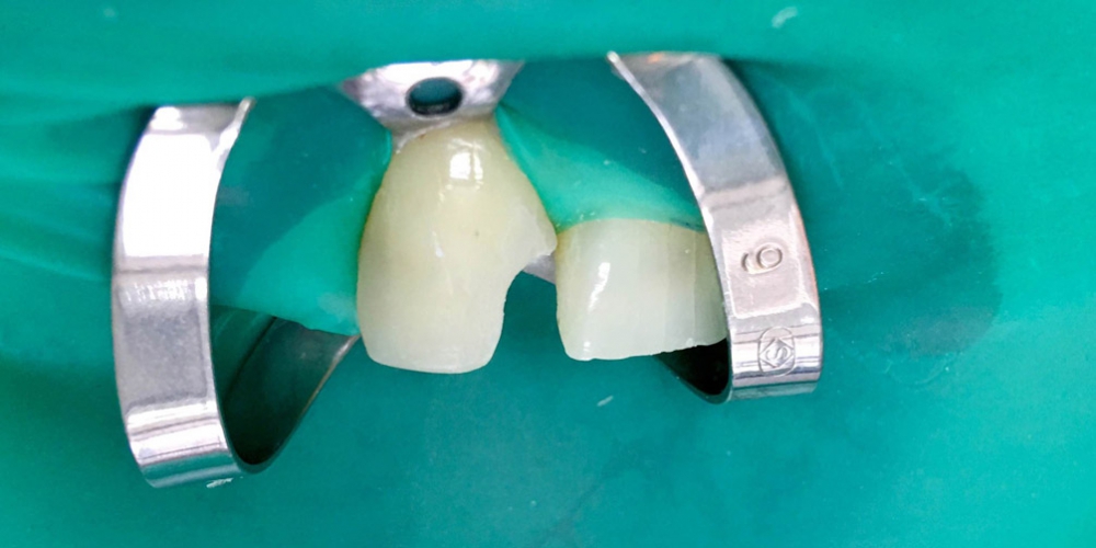  Эстетическая реставрация зуба с восстановлением анатомической формы