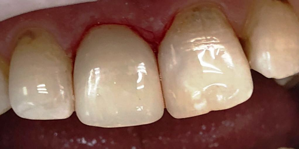  Реставрация переднего зуба под местным обезболиванием