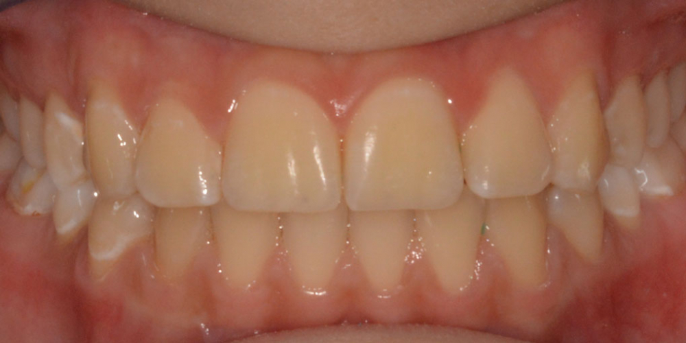  Исправление прикуса выпирающего зуба на верхней челюсти