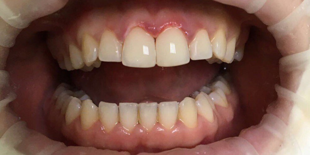 Эстетическая реставрация центральных резцов с восстановлением анатомической формы зубов