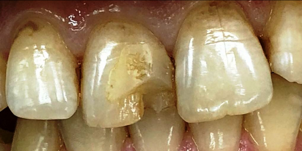  Реставрация переднего зуба под местным обезболиванием