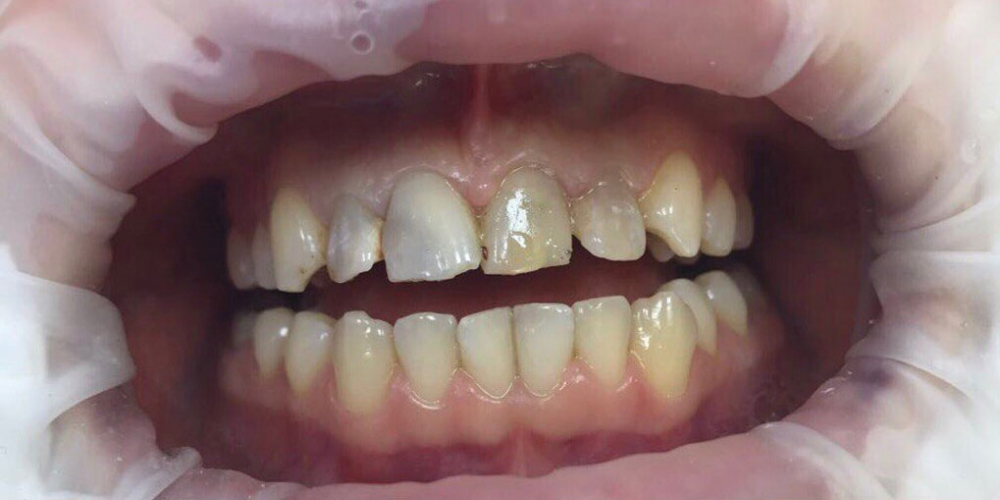  Эндодонтическое лечение и реставрация передних зубов