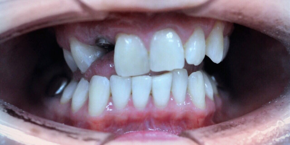  Отбеливание зубов системой ZOOM, фото до и после
