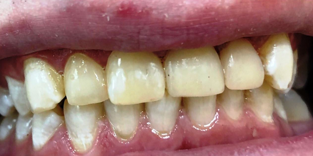  Художественная реставрация фронтальныx зубов нанокомпозитным материалом Estelite ASTERIA