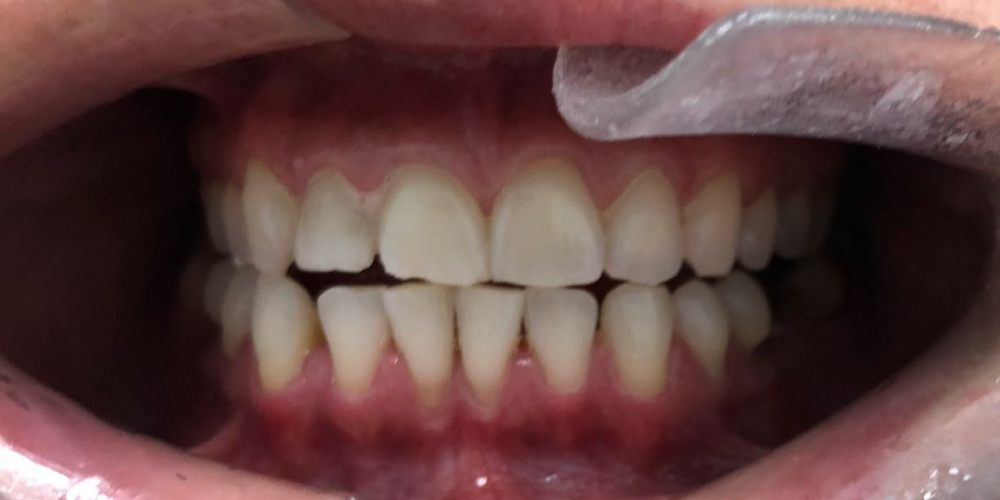  Отбеливание зубов системой ZOOM, результат до и после