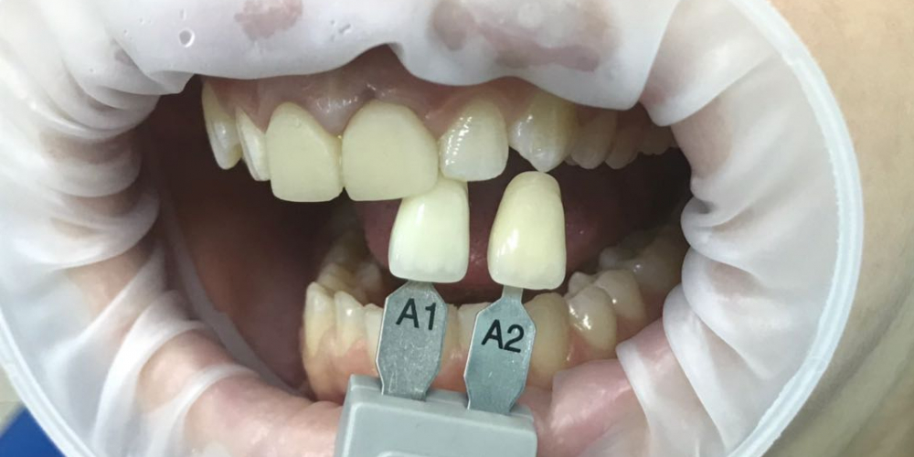  Коронки E-max на два передних зуба на верхней челюсти