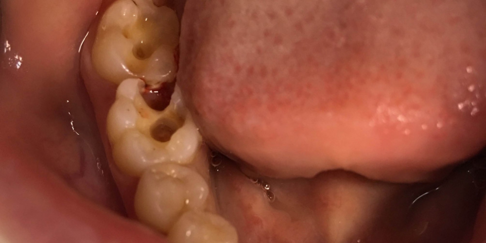  Лечение кариесов жевательной группы зубов