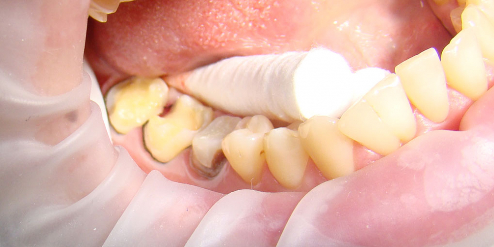  Восстановление коронковой части зубов цельнокерамическими вкладками E-max press
