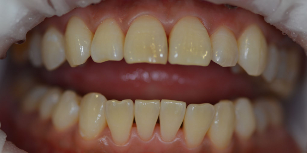  Результат отбеливания зубов Opalescence BOOST