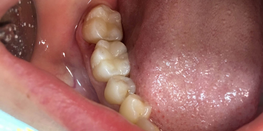  Лечение кариесов жевательной группы зубов