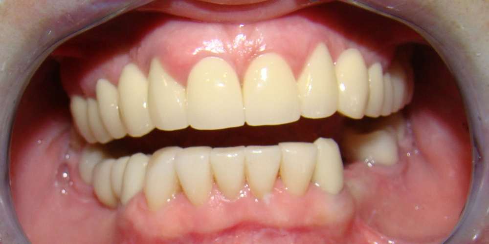  Протезирование передних зубов нижней челюсти винирами