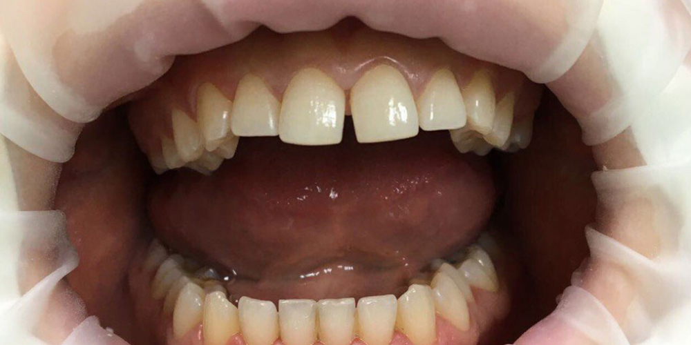  Эстетическая реставрация центральных резцов с восстановлением анатомической формы зубов