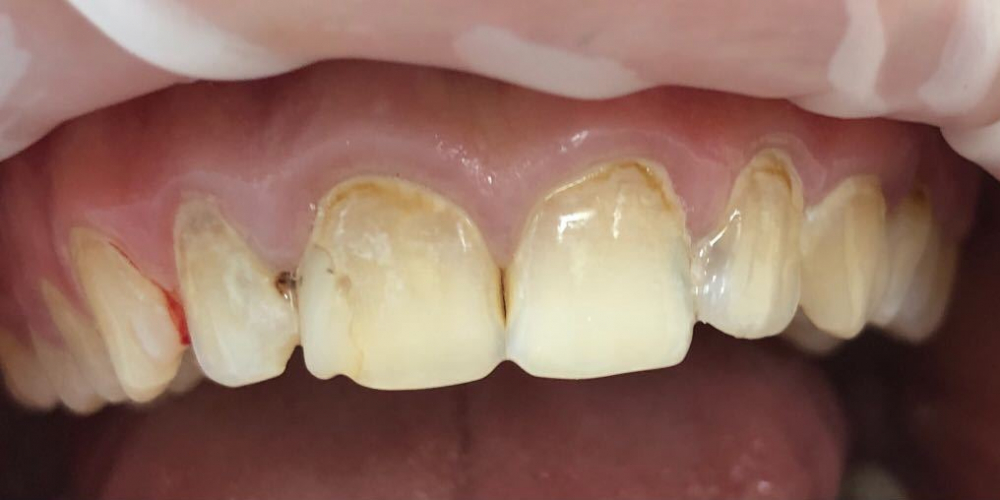  Восстановление анатомической формы зубов и реставрация зубов