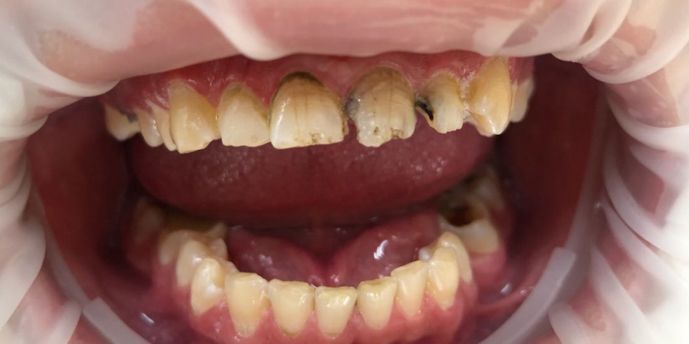  Художественная реставрация фронтальныx зубов нанокомпозитным материалом Estelite ASTERIA