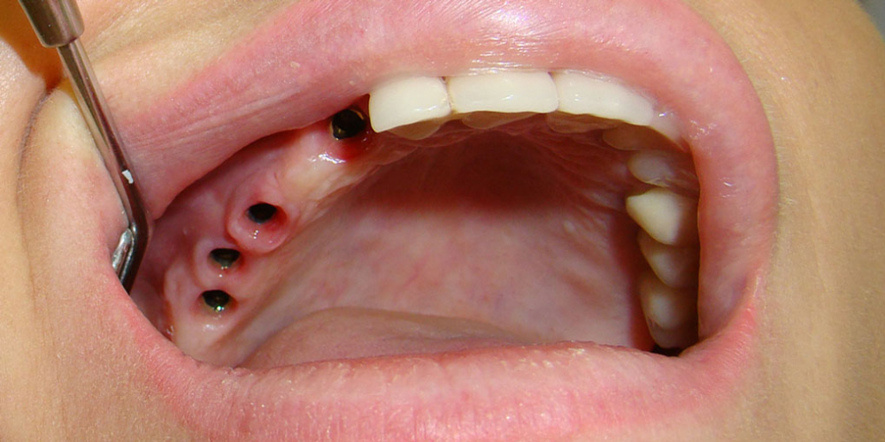 В первое посещение была проведена установка имплантов Nobel Biocear в позицию зубов 1.3, 1.5, 1.6, 1.7. Время выполнения операции составило 120 минут. 

На втором посещении в импланты были установлены формирователи десны для формирования мягких тканей. Результат восстановления зубов мостовидным протезом на имплантах