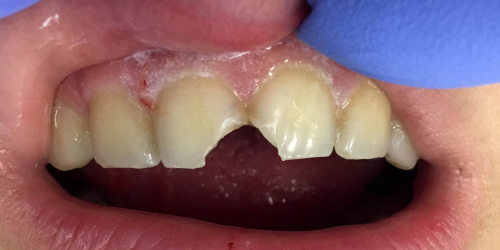  Эстетическая реставрация передней группы зубов