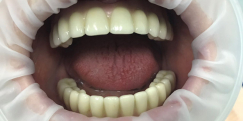 Восстановление зубного ряда нижней и верхней челюстях на имплататах фото после лечения