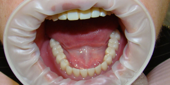 Протезирование нижней челюсти при полном отсутствии зубов имплантатами Nobel Procera фото после лечения