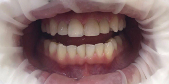 Эндодонтическое лечение и реставрация передних зубов фото после лечения