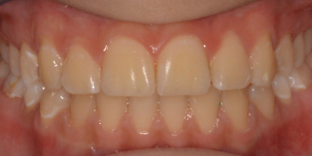 Исправление прикуса выпирающего зуба на верхней челюсти фото после лечения