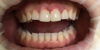 Эстетическая реставрация центральных резцов с восстановлением анатомической формы зубов фото после лечения