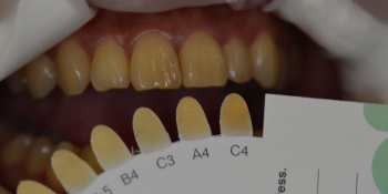 Результат отбеливания зубов Opalescence BOOST фото до лечения