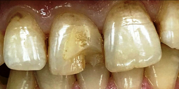 Реставрация переднего зуба под местным обезболиванием фото до лечения