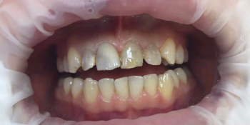 Эндодонтическое лечение и реставрация передних зубов фото до лечения