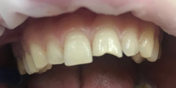 Эстетическая реставрация переднего зуба фото до лечения