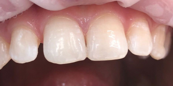 Реставрация зубов фронтального отдела фото до лечения