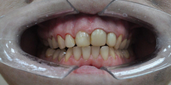 Результат отбеливания зубов ZOOM + чистка фото до лечения