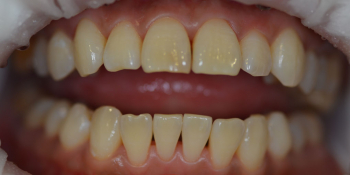 Результат отбеливания зубов Opalescence BOOST фото после лечения