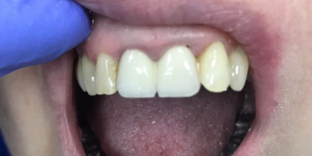 Исправили проблемы с передними зубами циркониевыми коронками фото до лечения