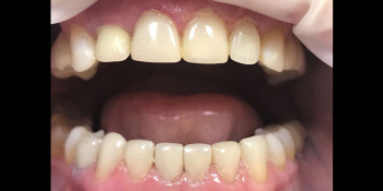 Художественная реставрация фронтальных зубов нанокомпозитным материалом Estelite ASTERIA фото после лечения
