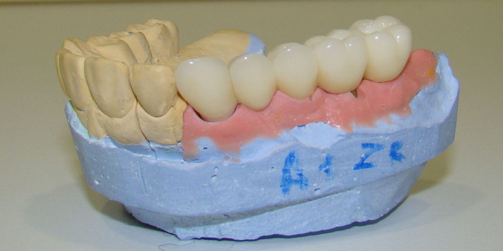  Результат восстановления зубов мостовидным протезом на имплантах