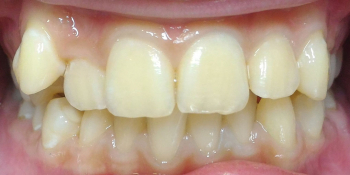 Исправление прикуса выпирающего зуба на верхней челюсти фото до лечения