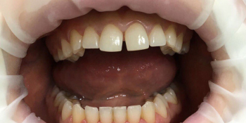Эстетическая реставрация центральных резцов с восстановлением анатомической формы зубов фото до лечения
