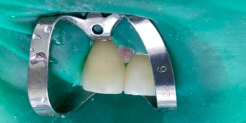 Эстетическая реставрация зуба с восстановлением анатомической формы фото после лечения