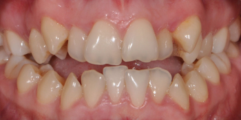 Жалобы на неровные зубы и некрасивую улыбку фото до лечения