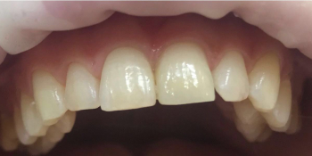 Эстетическая реставрация переднего зуба фото после лечения