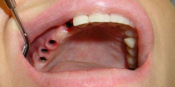 Результат восстановления зубов мостовидным протезом на имплантах фото до лечения