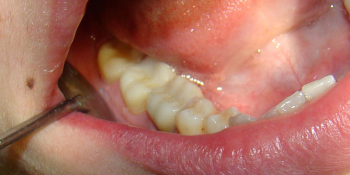 Восстановление коронковой части зубов цельнокерамическими вкладками E-max press фото после лечения