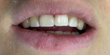 Эстетическая реставрация передней группы зубов фото после лечения