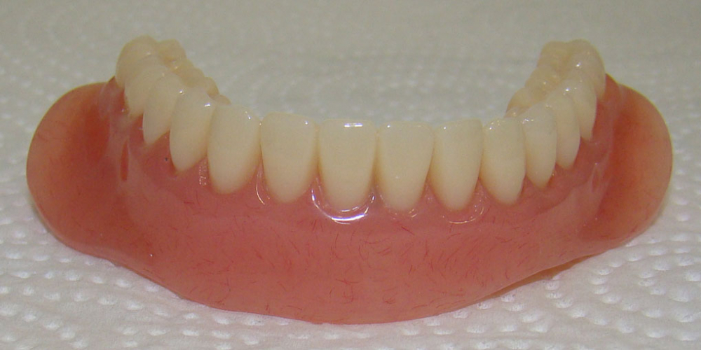 Протез. Протезирование нижней челюсти при полном отсутствии зубов имплантатами Nobel Procera